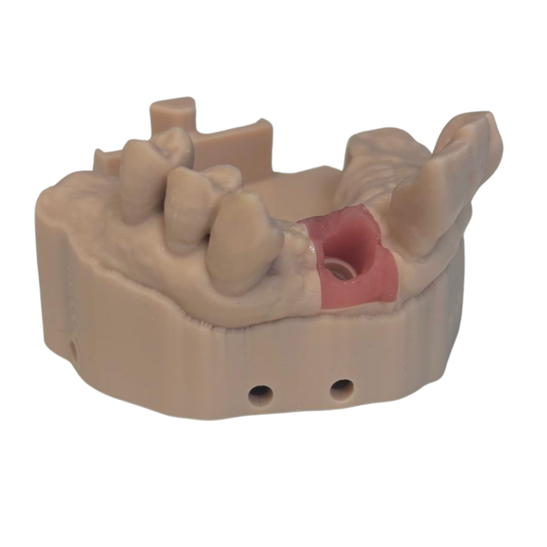 3D printed dental implant model with precision gingival detail
